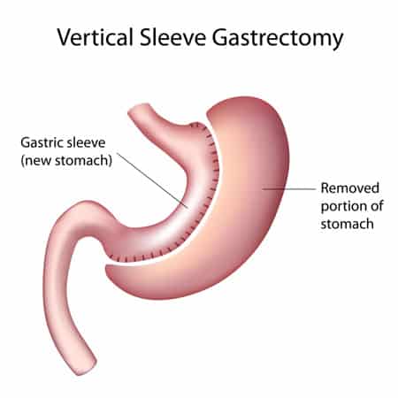 sleeve gastrectomy sydney