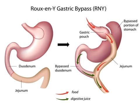 img-med-rny-gastric-bypass gastric bypass surgery sydney
