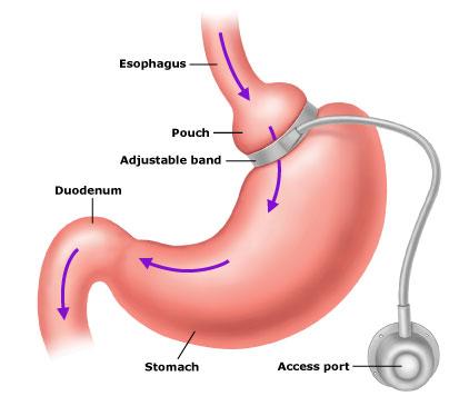 lap_adjustable_gastric_band1 gastric banding sydney