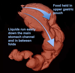 Endoscopic Sleeve Gastroplasty