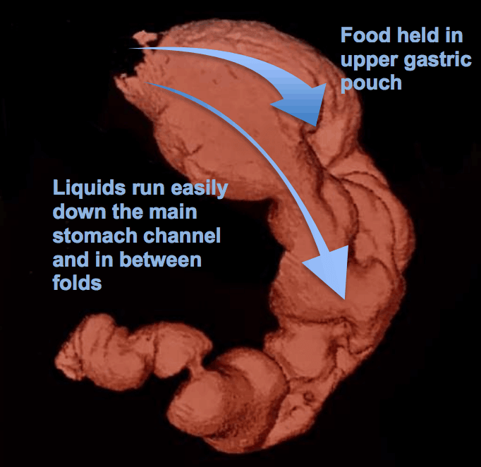 Endoscopic Sleeve Gastroplasty