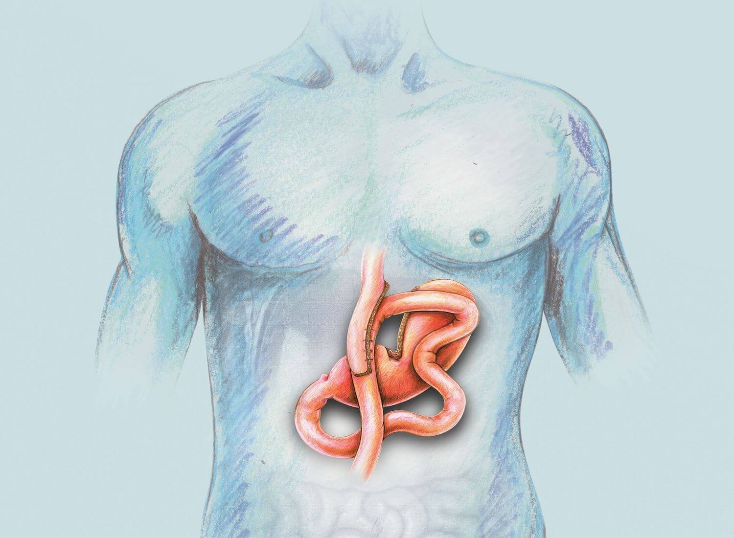 Laparoscopic_omega_loop_bypass-cropped