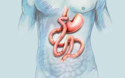 Navigating Gastric Bypass Surgery Options: What You Need to Know